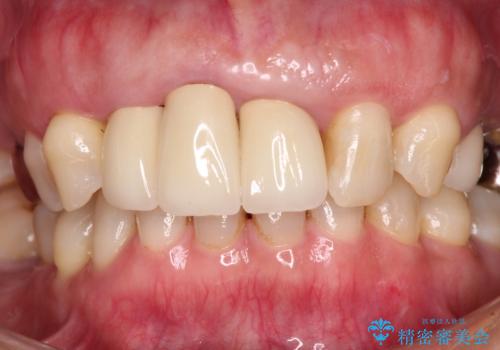 歯茎の縁に見える変色を隠したい 前歯のオールセラミッククラウンの治療後