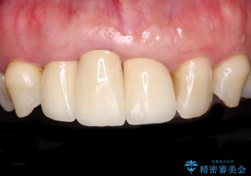 歯茎の縁に見える変色を隠したい　前歯のオールセラミッククラウンの症例 治療後