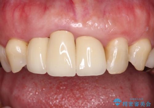 歯茎の縁に見える変色を隠したい 前歯のオールセラミッククラウンの治療後