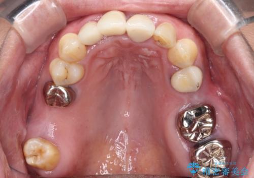 歯茎の縁に見える変色を隠したい 前歯のオールセラミッククラウンの治療後