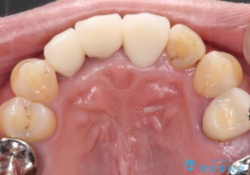 歯茎の縁に見える変色を隠したい 前歯のオールセラミッククラウンの治療後