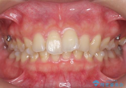 深いかみ合わせ 出っ歯の治療 インビザラインでの治療中
