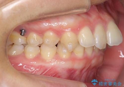 深いかみ合わせ 出っ歯の治療 インビザラインでの治療中