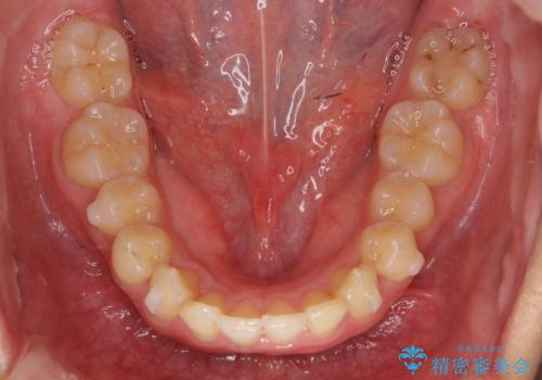 深いかみ合わせ 出っ歯の治療 インビザラインでの治療中