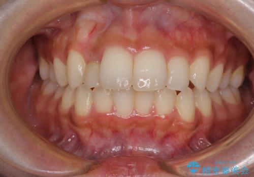 抜けてしまうと言われた前歯 インビザラインによる矯正治療の症例 治療前