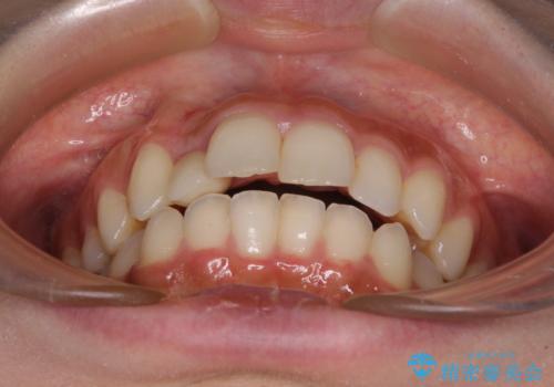 抜けてしまうと言われた前歯 インビザラインによる矯正治療の治療前