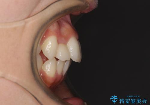 抜けてしまうと言われた前歯 インビザラインによる矯正治療の治療前