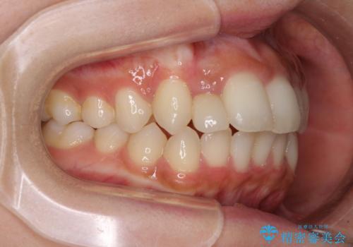 抜けてしまうと言われた前歯 インビザラインによる矯正治療の治療前