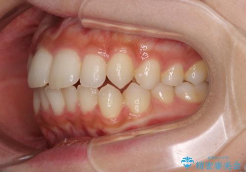 抜けてしまうと言われた前歯 インビザラインによる矯正治療の治療前