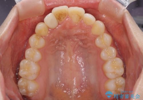 抜けてしまうと言われた前歯 インビザラインによる矯正治療の治療前