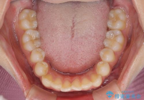 抜けてしまうと言われた前歯 インビザラインによる矯正治療の治療前