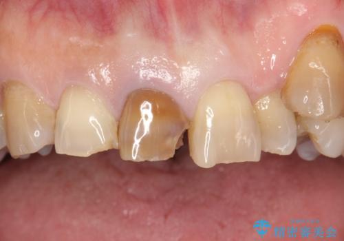 セラミックによる前歯の変色の改善の治療前