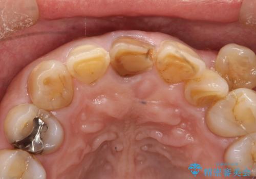 セラミックによる前歯の変色の改善の治療前