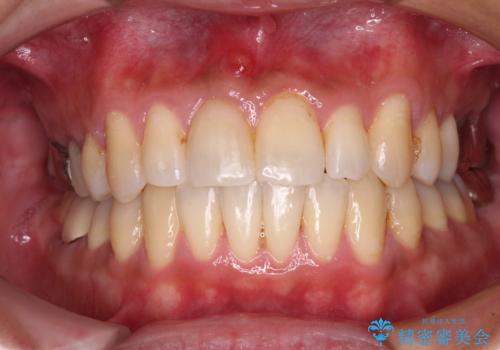 受け口傾向の咬み合わせ　前歯のデコボコをワイヤー矯正で素早く改善の症例 治療後