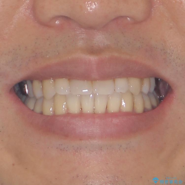 受け口傾向の咬み合わせ　前歯のデコボコをワイヤー矯正で素早く改善の治療後（顔貌）