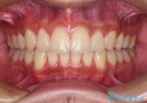 矯正治療の後戻りをインビザライン・ライトで解消の治療後