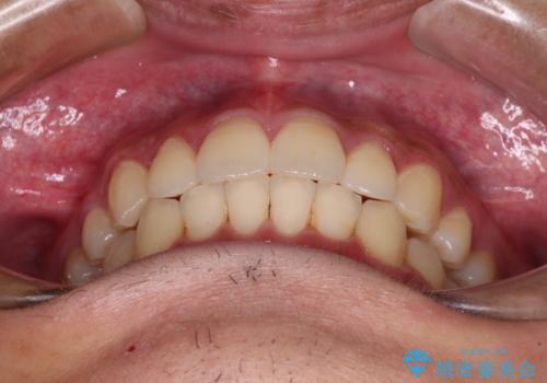 矯正治療の後戻りをインビザライン・ライトで解消の治療後