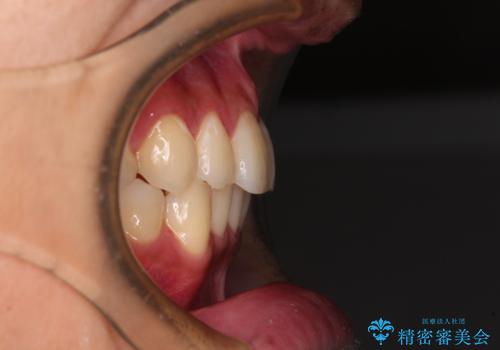 矯正治療の後戻りをインビザライン・ライトで解消の治療後