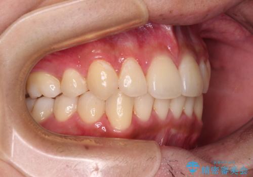 矯正治療の後戻りをインビザライン・ライトで解消の治療後