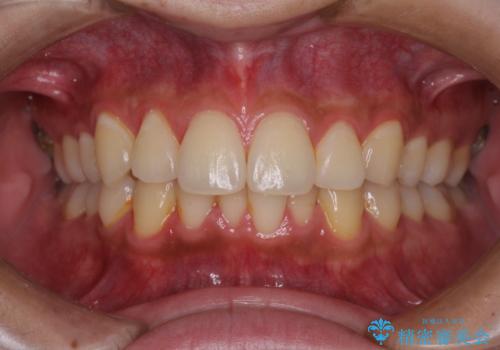 矯正治療の後戻りをインビザライン・ライトで解消の治療前