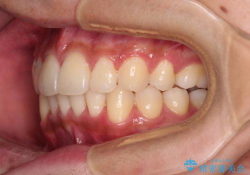 矯正治療の後戻りをインビザライン・ライトで解消の治療後