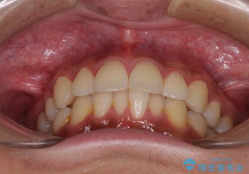 矯正治療の後戻りをインビザライン・ライトで解消の治療前