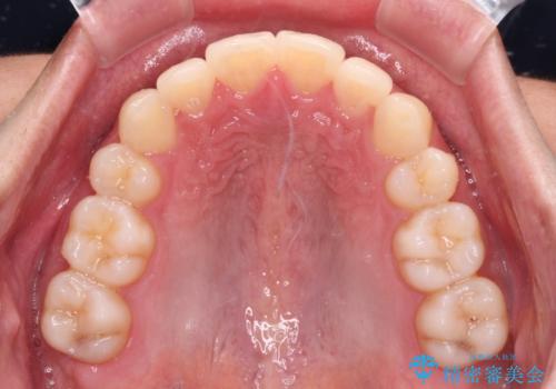 矯正治療の後戻りをインビザライン・ライトで解消の治療後