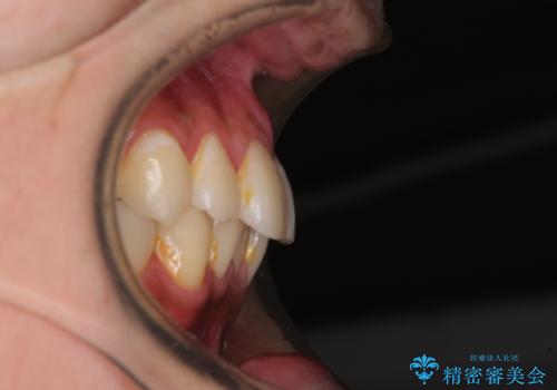 矯正治療の後戻りをインビザライン・ライトで解消の治療前