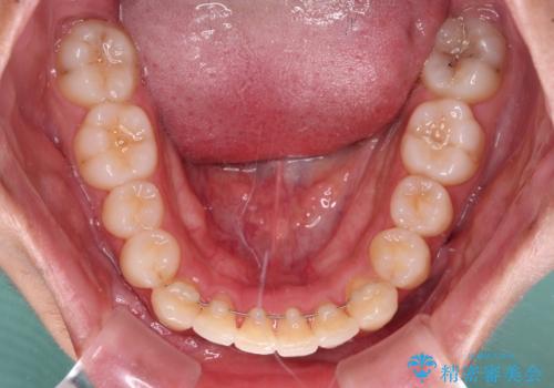 矯正治療の後戻りをインビザライン・ライトで解消の治療後