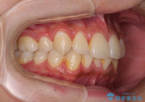 矯正治療の後戻りをインビザライン・ライトで解消の治療前