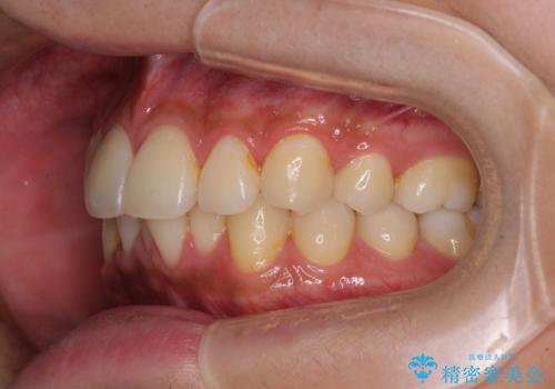 矯正治療の後戻りをインビザライン・ライトで解消の治療前