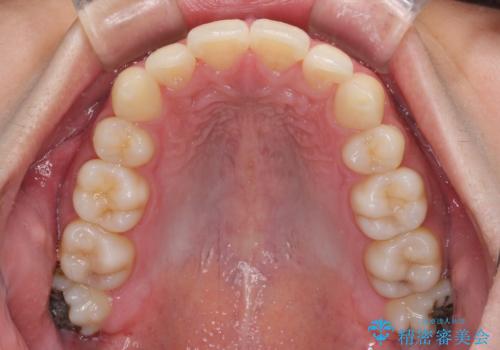 矯正治療の後戻りをインビザライン・ライトで解消の治療前