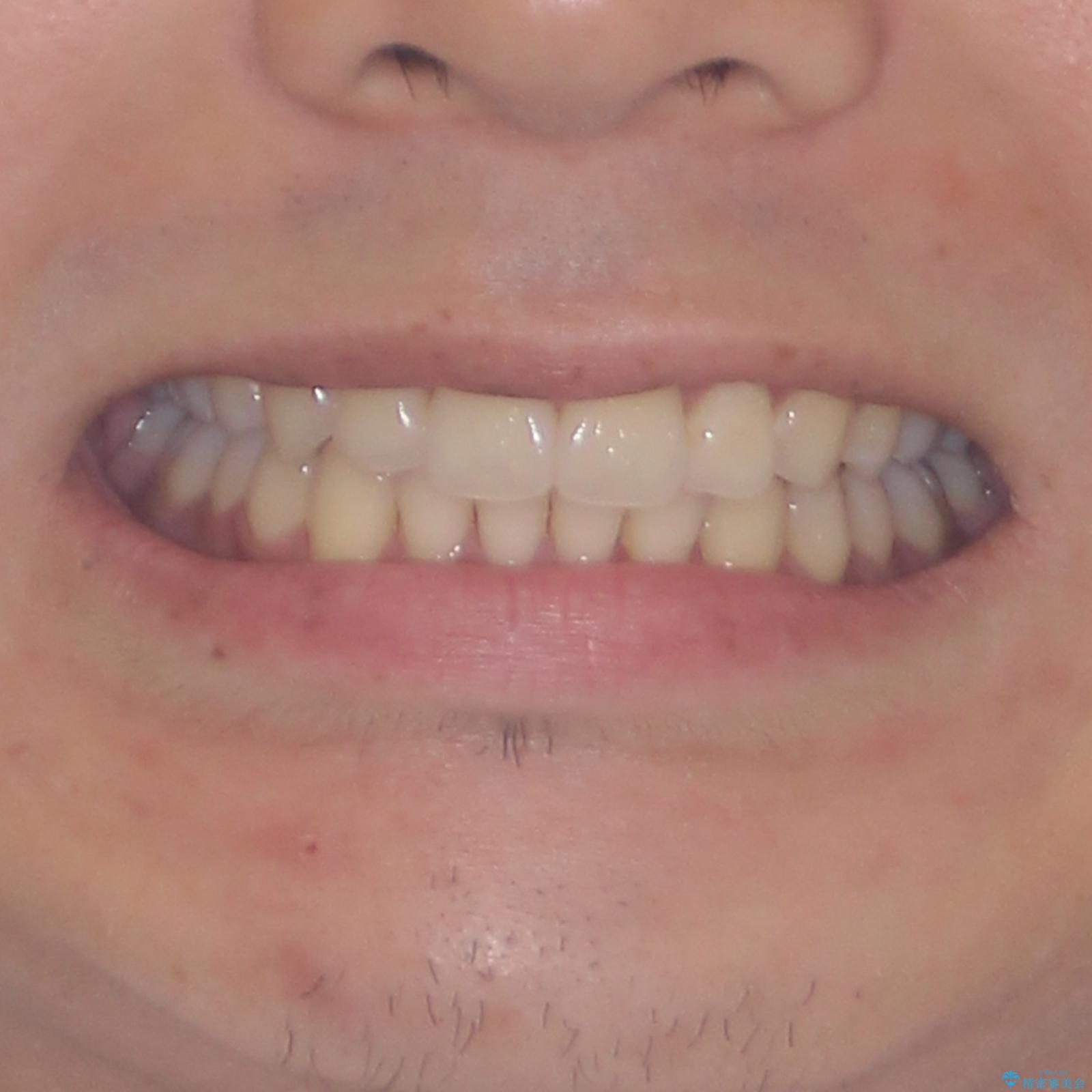 矯正治療の後戻りをインビザライン・ライトで解消の治療後(顔貌)