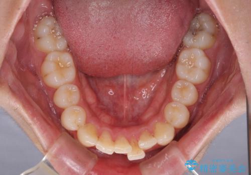 矯正治療の後戻りをインビザライン・ライトで解消の治療前