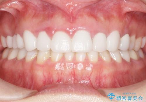 かぶせものと歯ぐきの境目が黒い 40代女性の治療後