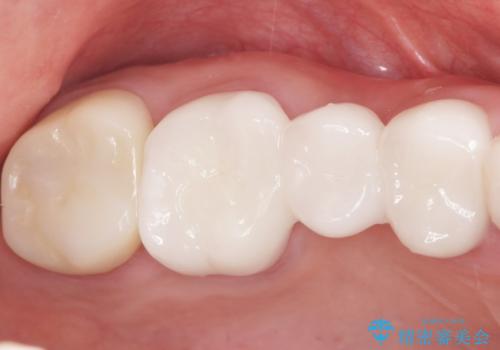 かぶせものと歯ぐきの境目が黒い 40代女性の治療後