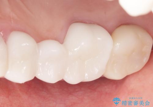 かぶせものと歯ぐきの境目が黒い 40代女性の治療後