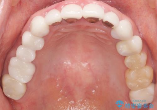 かぶせものと歯ぐきの境目が黒い 40代女性の治療後