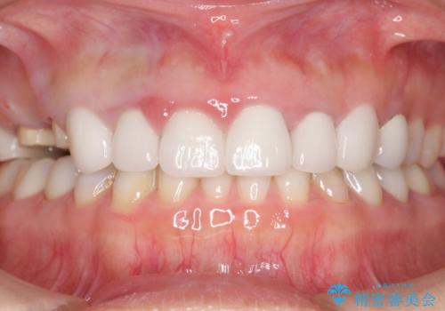 かぶせものと歯ぐきの境目が黒い 40代女性の治療中