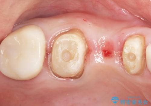 かぶせものと歯ぐきの境目が黒い 40代女性の治療中