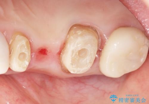 かぶせものと歯ぐきの境目が黒い 40代女性の治療中