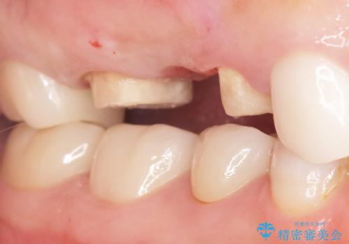 かぶせものと歯ぐきの境目が黒い 40代女性の治療中