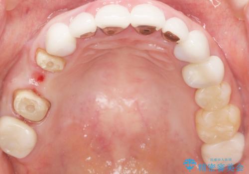 かぶせものと歯ぐきの境目が黒い 40代女性の治療中