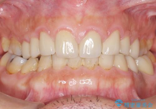 古い被せ物をセラミックにしたい 40代男性の治療後