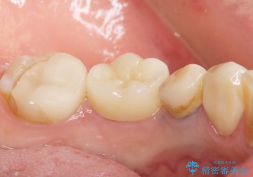 古い被せ物をセラミックにしたい 40代男性の治療後