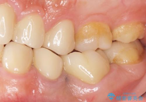 古い被せ物をセラミックにしたい 40代男性の治療後