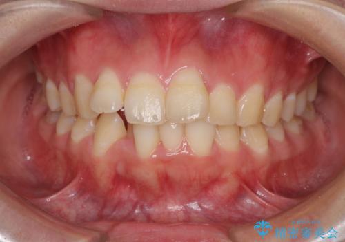 前歯の出っ歯と口の閉じにくさを抜歯矯正で改善　目立たないワイヤー矯正の症例 治療前