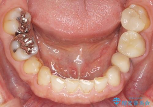 古い被せ物をセラミックにしたい 40代男性の治療後