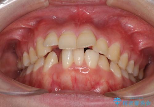 前歯の出っ歯と口の閉じにくさを抜歯矯正で改善 目立たないワイヤー矯正の治療前