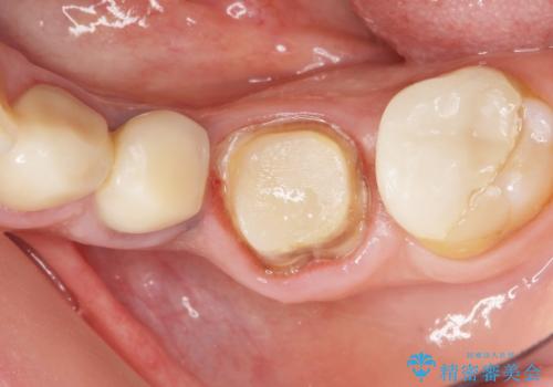 古い被せ物をセラミックにしたい 40代男性の治療中
